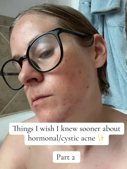 I spent years trying to figure out how to fix my acne. So many dermato